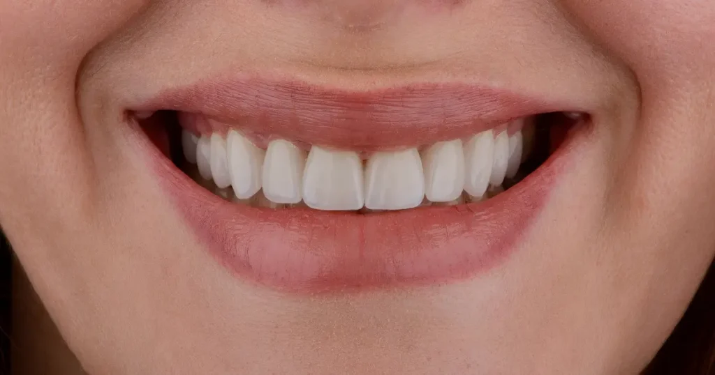 smiling mouth with perfectly restored teeth, showing the results of full mouth restoration in In West Linn, OR