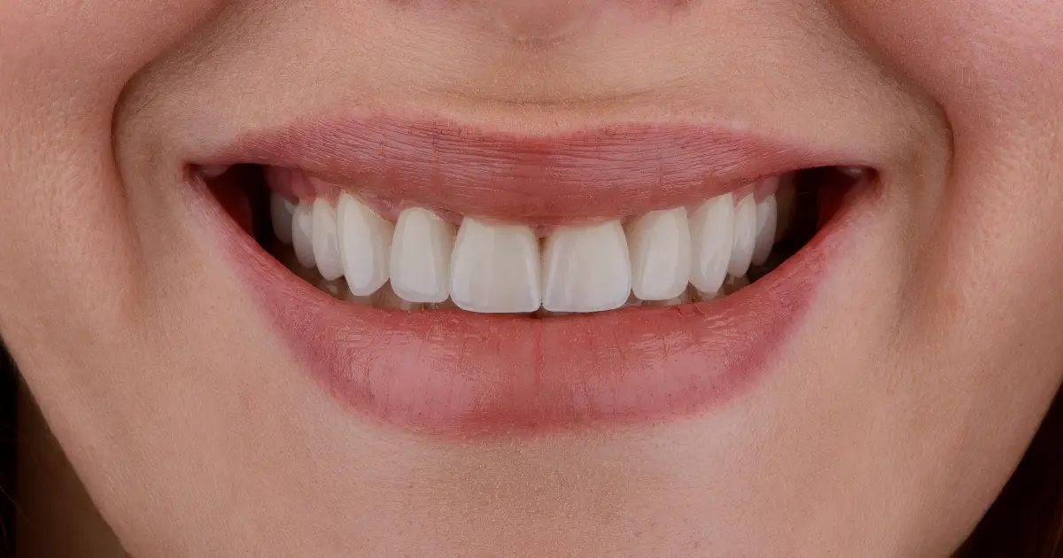 smiling mouth with perfectly restored teeth, showing the results of full mouth restoration in In West Linn, OR